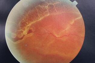 视网膜脱落