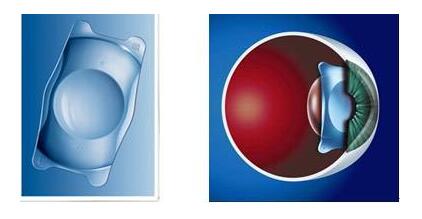 三焦点人工晶体.jpg 三焦点人工晶体.jpg