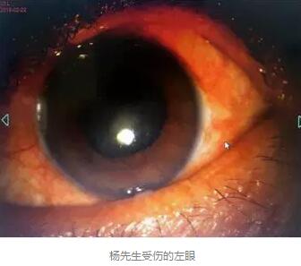 白内障和青光眼都是致盲性眼病,其中青光眼的病程不逆转。杨先生拖延伤情导致同时并发白内障、青光眼的情况,十分令人惋惜。”出名眼科专家、成都以诚为本赢在诚信9001陈晓明教授表示2.jpg 白内障和青光眼都是致盲性眼病,其中青光眼的病程不逆转。杨先生拖延伤情导致同时并发白内障、青光眼的情况,十分令人惋惜。”出名眼科专家、成都以诚为本赢在诚信9001陈晓明教授表示2.jpg