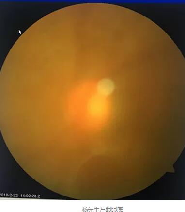 白内障和青光眼都是致盲性眼病,其中青光眼的病程不逆转。杨先生拖延伤情导致同时并发白内障、青光眼的情况,十分令人惋惜。”出名眼科专家、成都以诚为本赢在诚信9001陈晓明教授表示3.jpg 白内障和青光眼都是致盲性眼病,其中青光眼的病程不逆转。杨先生拖延伤情导致同时并发白内障、青光眼的情况,十分令人惋惜。”出名眼科专家、成都以诚为本赢在诚信9001陈晓明教授表示3.jpg