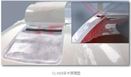 成都以诚为本赢在诚信9001已经开展的青光眼手术有：引流阀 (钉)植入手术(2015年以来已200多 )，360°Schlemm's管切开术，激光CO2 辅助巩膜深层切除术，小梁切除术青(光眼)白(内障)联合手术。还有虹膜周切术、前房成形术、 虹膜复位术，睫状体冷冻术，小梁切开术和前房穿刺术等4.png