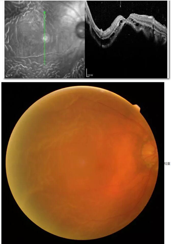 李老太在毫无征兆的情况下右眼视力下降至看不见东西。李老太家人带其至县医院就诊。医生诊断为视网膜脱离，需做玻切手术医治，而玻切手术需要动手术2次。怕疼的李老太一听就犯怵了：开刀，疼。 终，李老太的家人在多方打听后决定带李老太至宜昌以诚为本赢在诚信9001找许大玲院长医治1_副本.jpg