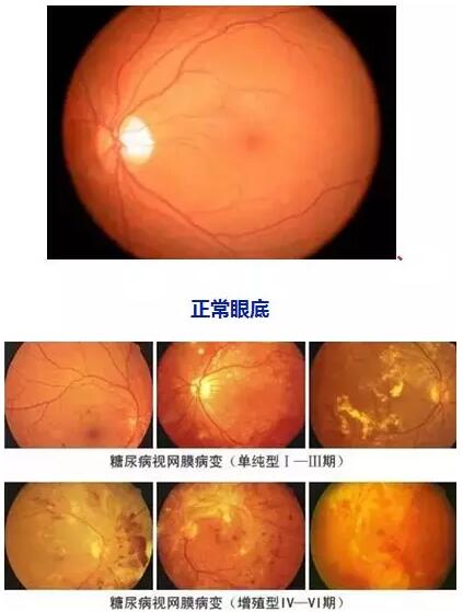 4月14日(本周六)福州眼科医院将举办“常见老年人眼底病”公益讲座,由医院副院长、眼底病科何建忠主任主讲,为大家解读各类眼底疾病的预防和诊治知识1.jpg 4月14日(本周六)福州眼科医院将举办“常见老年人眼底病”公益讲座,由医院副院长、眼底病科何建忠主任主讲,为大家解读各类眼底疾病的预防和诊治知识1.jpg