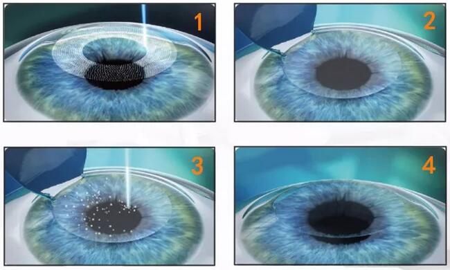近视加散光想要 ,飞秒全激光近视手术是很好的选择。 一*次近视激光手术,就可以同时 近视、合并散光。2.jpg 近视加散光想要 ,飞秒全激光近视手术是很好的选择。 一*次近视激光手术,就可以同时 近视、合并散光。2.jpg