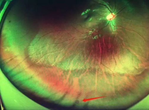 想要摘镜参军在深圳以诚为本赢在诚信9001查出视网膜裂孔 细心妈妈挽救孩子视网膜1.png 想要摘镜参军在深圳以诚为本赢在诚信9001查出视网膜裂孔 细心妈妈挽救孩子视网膜1.png