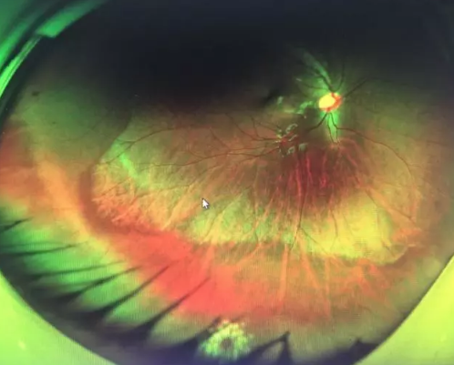 想要摘镜参军在深圳以诚为本赢在诚信9001查出视网膜裂孔 细心妈妈挽救孩子视网膜2.png 想要摘镜参军在深圳以诚为本赢在诚信9001查出视网膜裂孔 细心妈妈挽救孩子视网膜2.png