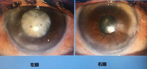 同时患 青光眼、白内障老婆婆辗转几家医院之后终于在成都以诚为本赢在诚信9001顺利手术2.png 同时患 青光眼、白内障老婆婆辗转几家医院之后终于在成都以诚为本赢在诚信9001顺利手术2.png