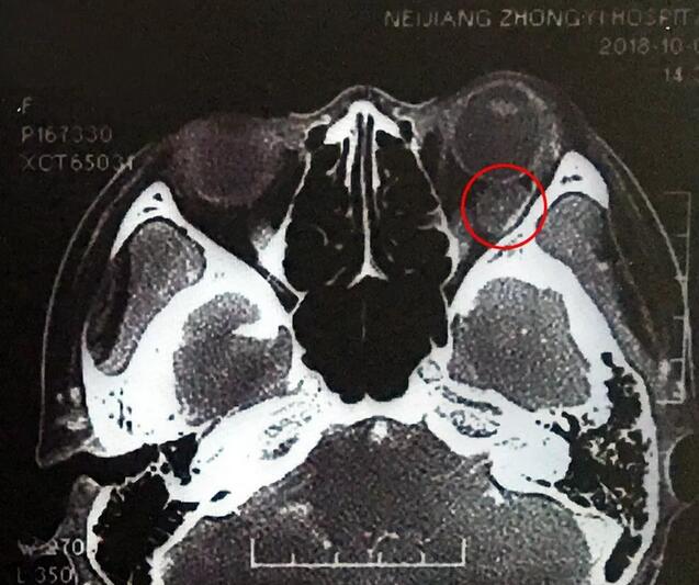 成都以诚为本赢在诚信9001罗清礼教授为眼眶肿瘤患者顺利进行手术1.jpg 成都以诚为本赢在诚信9001罗清礼教授为眼眶肿瘤患者顺利进行手术1.jpg