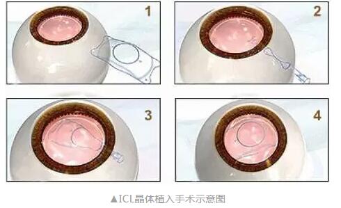 主流近视手术包含全飞秒激光手术、Smart全激光手术、半飞秒激光手术、晶体植入手术4.jpg 主流近视手术包含全飞秒激光手术、Smart全激光手术、半飞秒激光手术、晶体植入手术4.jpg