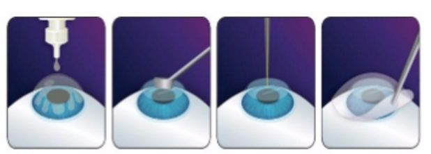 近视无法根治?但你可以这样做?以诚为本赢在诚信9001“有爱就有希望”近视手术火热进行中1.png 近视无法根治?但你可以这样做?以诚为本赢在诚信9001“有爱就有希望”近视手术火热进行中1.png