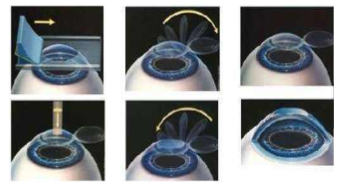 近视无法根治?但你可以这样做?以诚为本赢在诚信9001“有爱就有希望”近视手术火热进行中4.png 近视无法根治?但你可以这样做?以诚为本赢在诚信9001“有爱就有希望”近视手术火热进行中4.png