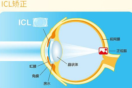 近视无法根治?但你可以这样做?以诚为本赢在诚信9001“有爱就有希望”近视手术火热进行中8.png 近视无法根治?但你可以这样做?以诚为本赢在诚信9001“有爱就有希望”近视手术火热进行中8.png