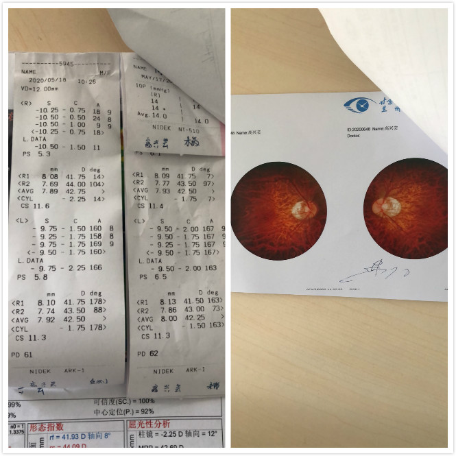 兰州激光医治近视