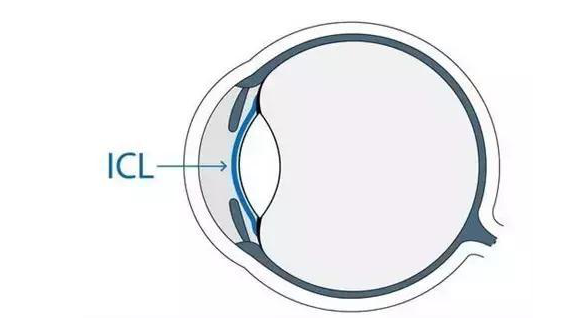在杭州以诚为本赢在诚信9001高度近视手术后,近视2550度配不到眼镜的四川大哥,看清了!4.png 在杭州以诚为本赢在诚信9001高度近视手术后,近视2550度配不到眼镜的四川大哥,看清了!4.png